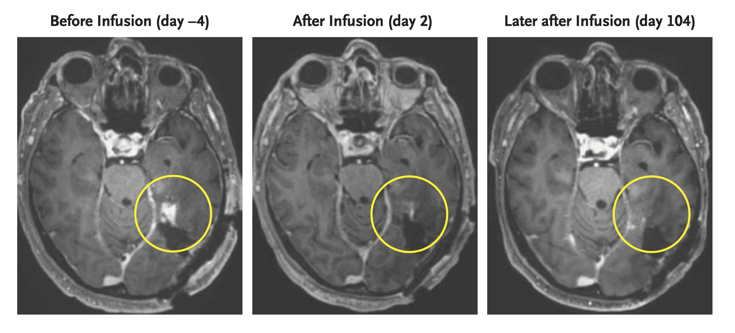 NextImg:Cell therapy appears to shrink aggressive brain tumors - Washington Examiner